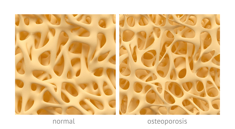 normaalse struktuuriga luu ja osteoporoosiga luu struktuuriga luu